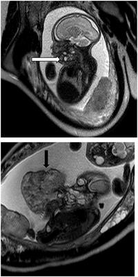 EXIT (ex utero Intrapartum Treatment) to Airway Procedure for Twin Fetuses With Oropharyngeal Teratomas: Lessons Learned